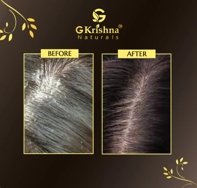 G Krishna Naturals - Advanced Anti-Dandruff Kit